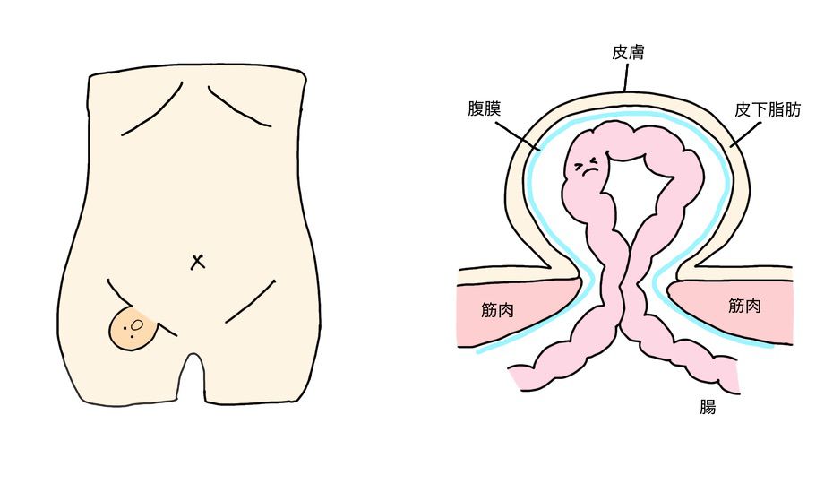 鼠径部のしこり、鼠径ヘルニア（脱腸）