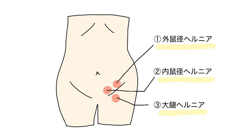 外鼠径ヘルニア、内鼠径ヘルニア、大腿ヘルニアの違い